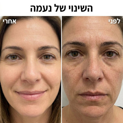 מכשיר חשמלי להסרת שחורים מהאף עם טכנולוגיית שאיבה לניקוי נקבוביות עמוק, להסרת שומן, לכלוך וראשים שחורים בקלות.